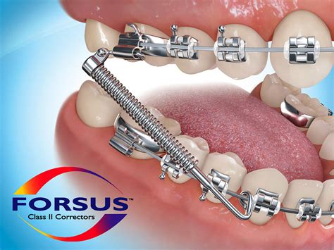 Orthodontic Appliances And Spacers Marc Allen Orthodontics