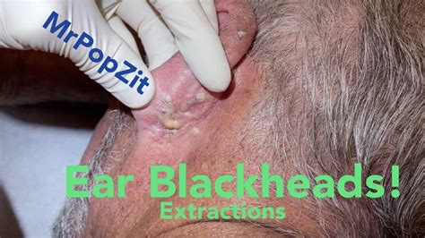 Ear Blackhead Extractions Multiple Techniques Used For Deep Embedded