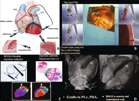 Stem Cells In Treatment Of Coronary Heart Disease And Its Monitoring