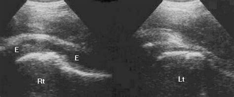 Ultrasound representation of fluid in the hip joint. E effusion in the... | Download Scientific ...