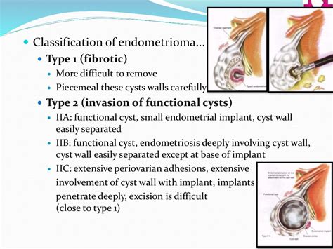 Laparoscopic Management Of Endometriosis