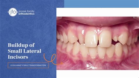 Buildup Of Small Lateral Incisors Orthodontic And Dental Collaboration