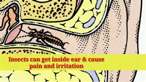 Insect Inside Ear First Aid Dr Jayagar Ent And General Clinic Youtube