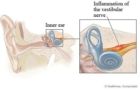 Vestibular Neuronitis Ent Clinic