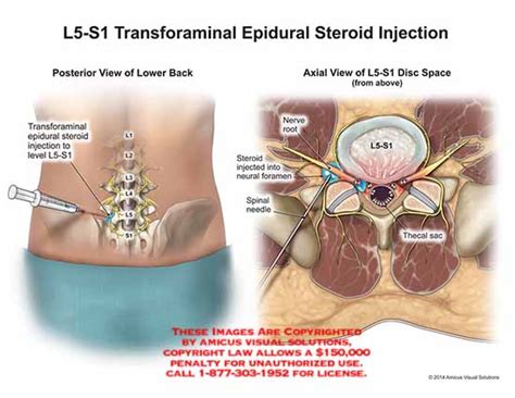 Amicus Illustration Of Amicus Surgery Posterior View Lower Back