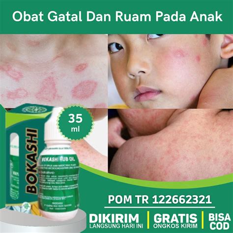 Obat Gatal Untuk Anak Homecare24