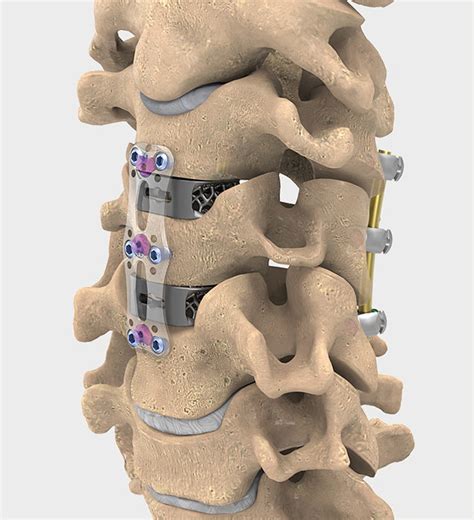 Nuvasive Acdf Anterior Cervical Plate Acp System