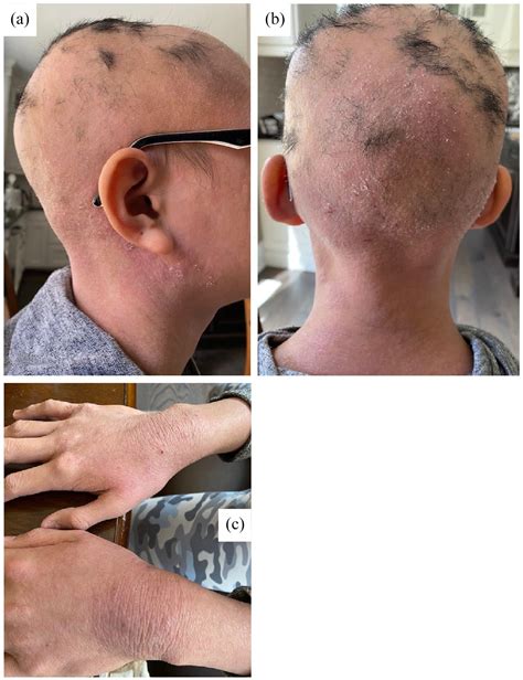 Upadacitinib For The Treatment Of Alopecia Areata And Severe Atopic Dermatitis In A Paediatric