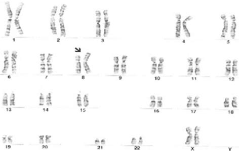 Karyotyping showing duplication of chromosome 8(p21.3p23.1) in the ...