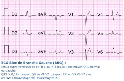 ECG facile les blocs de branche Médecine d urgence Urgences médicales