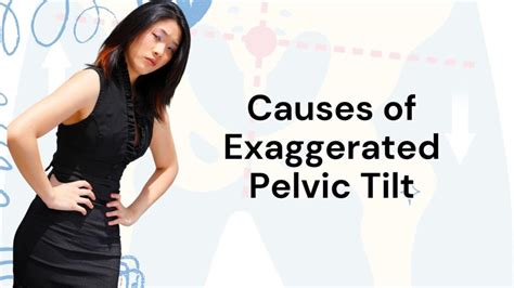 Understanding Pelvic Tilt, Dynamics, Misconceptions And The Role Of ...