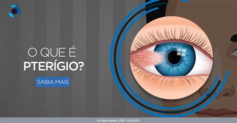 O Que Significa Pterígio - Você sabe o que é pterígio? Dr. Edson Iramina - Oftalmologia