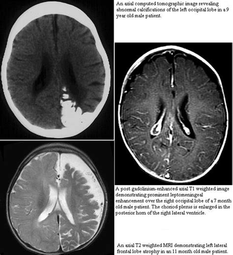 Sturge Weber Mri