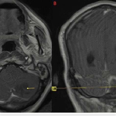 Postoperative Mri Of The Brain T Weighted Postcontrast Imaging In The