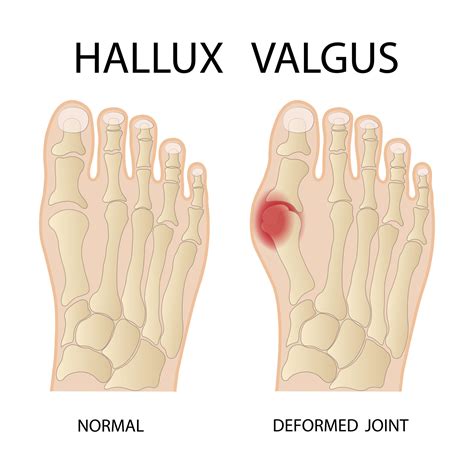 Hallux valgus medical infographic. Vector illustration. 9658254 Vector