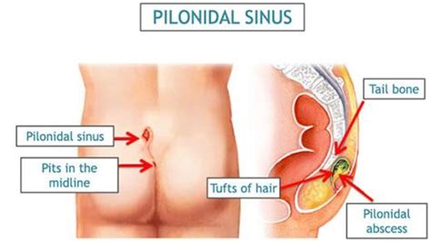 Pilodinal Sinus Cyst And Its Homeopathic Management