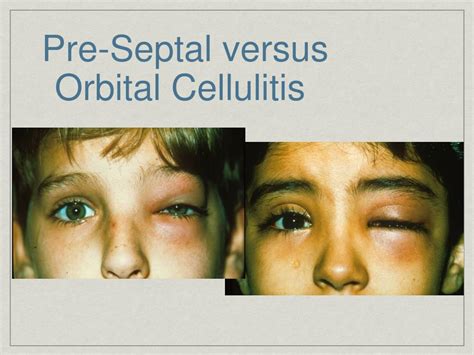 orbital cellulitis  periorbital cellulitis