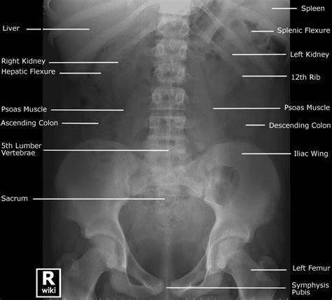 Unique How To Interpret An Abdominal X Ray Non Chronological Report Tes