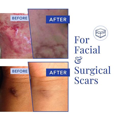 Rejuvaskin Scar Heal Kit - Medium Scar Treatment with Silicone Sheets