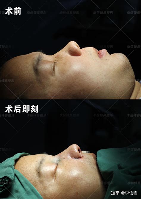 男士隆鼻 初鼻案例，术后即刻对比—深圳李信锋隆鼻综合整形案例分享 知乎