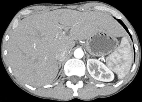 Ruptured Hepatic Artery Aneurysm A Novel Approach To Distal Control