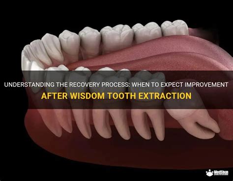 Understanding The Recovery Process When To Expect Improvement After Wisdom Tooth Extraction