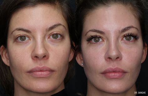 Under Eye Fillers Surrey Langley White Rock Cloverdale Bc