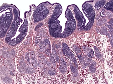 Lingual Tonsil Histology