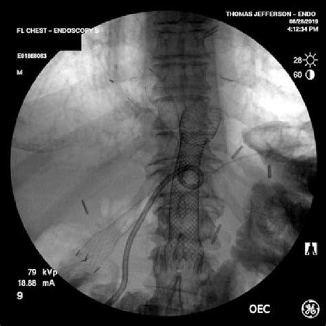 A Fcsems Placed Across The Dj Into The Efferent Limb And A Second