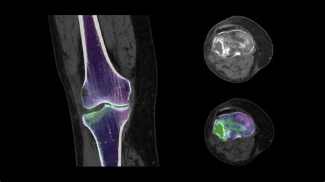 Dual Energy Ct Spectral Imaging Siemens Healthineers Usa