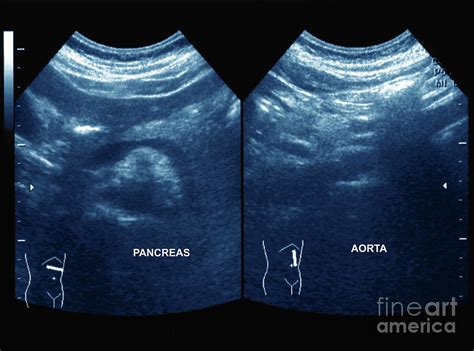 Normal Pancreas And Aorta Photograph By Zephyrscience Photo Library Fine Art America