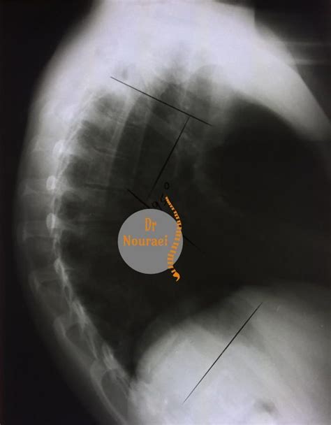 Spine Deformity - Dr Nouraei