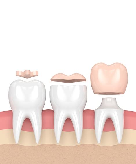 Dental Inlays And Onlays Henderson Nv Chipped Tooth Dental