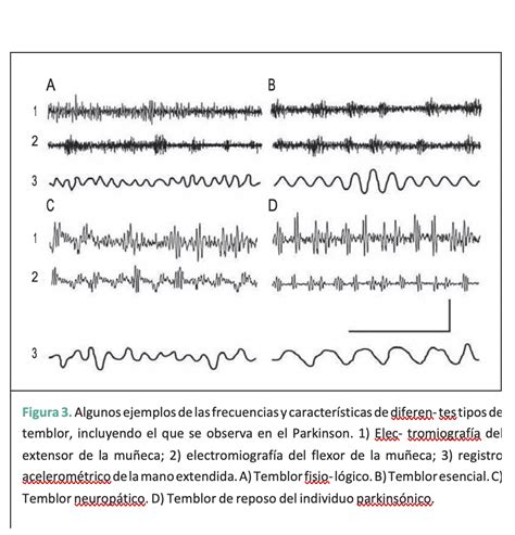 No Todo Lo Que Tiembla Es Parkinson Gaceta UNAM