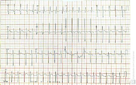 Electrocardiogram Showing Ectopic Atrial Rhythm With Right Ventricular