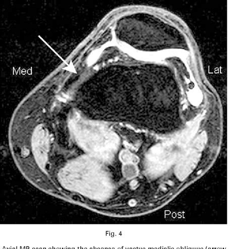 Vastus Medialis Oblique Mri