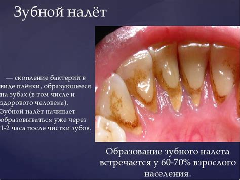Зубной налет