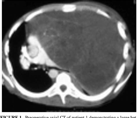 Figure 1 From The Growing Teratoma Syndrome In Primary Mediastinal