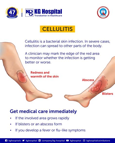 Severe Cellulitis Symptoms