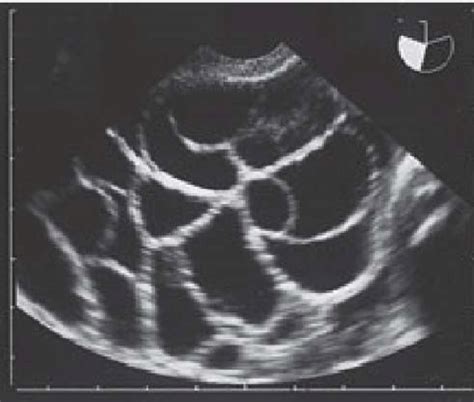 Ultrasound pelvis showing enlarged ovaries with multiple follicles,... | Download Scientific Diagram