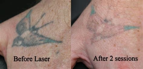 Laser Tattoos