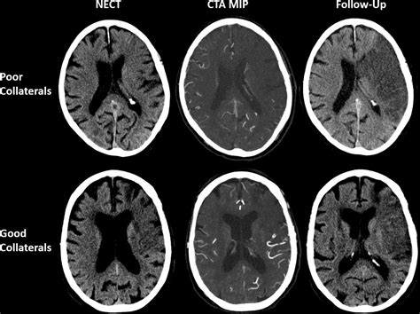 Patients With Low Alberta Stroke Program Early Ct Score Aspects But