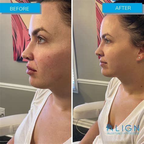 Before And After Cheek Filler Align Injectable Aesthetics