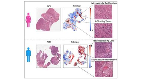 Ai Reveals Sex Specific Risks Associated With Brain Tumors Technology Networks