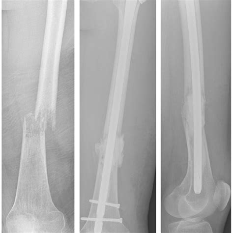 Measurement Of Metastatic Lesions In The Femur In Mm Largest Axial