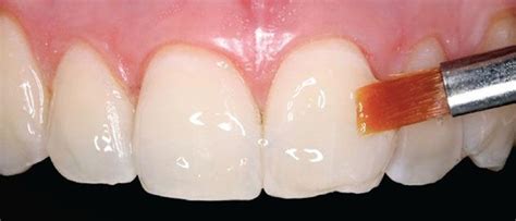 ¿cómo Ayuda El FlÚor A Proteger Los Dientes De La Caries