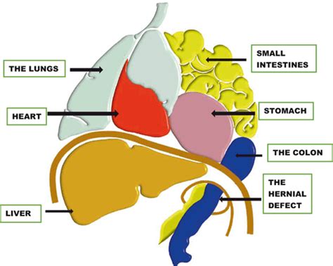 Diaphragmatic Hernia Diagram