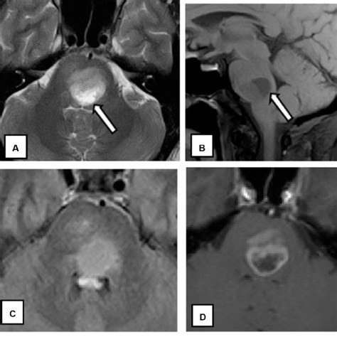 Trigeminal Nerve Mri