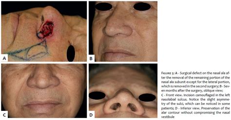 Surgical Cosmetic Dermatology Comparison Of Paramedian Forehead