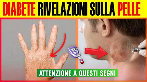 Diabete Indizi Che La Tua Pelle Svela E Che Dovresti Conoscere